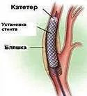 carotis stent beültetést