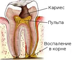 Кариесът причинява стъпка