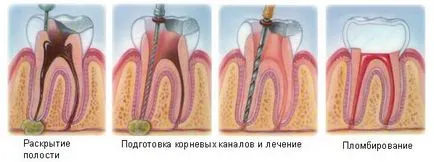 Киста на зъб, който е тя и как да се отнасяме - лечение на зъбите и отстраняване на кисти