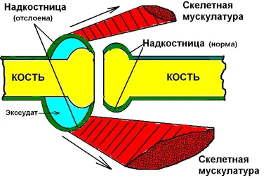 Compression невропатия светлини, преден interosseous, 1 цифрови нерви 