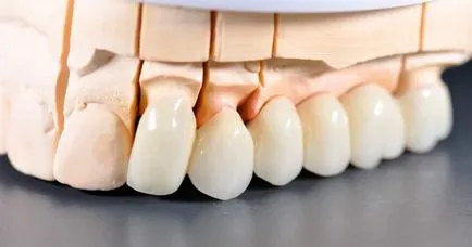 Корони от циркониев диоксид на плюсовете и минусите на зъбите, цена и мнения, производство и монтаж