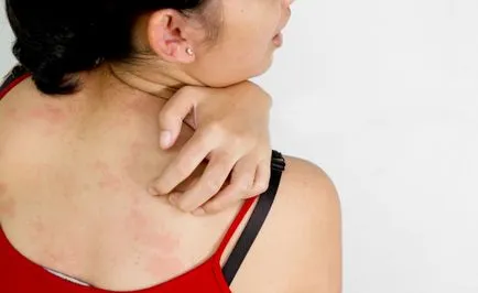 alergii ale pielii, care este, vitaportal - Sanatate si Medicina